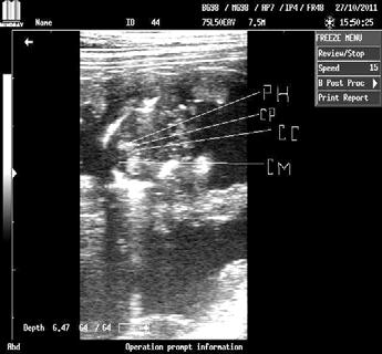 (21) Variety of fetal location and posture ويبين الشكل ٣ مقاطع مختلفة للرأس من بينھا المستوى القمي Coronal plane ذو الشكل البيضاوي ويالحظ في منتصفه خط المنصف لمنجل المخ Falx cerebri mid line والذي