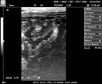 4 مع دقة في تشخيص الحمل عبر المستقيم وعبر جدار البطن للحاالت