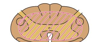 المتالزمات السريرة في آفات النخاع بعض متالزمة النخاع المركزي Central Cord Syndrome