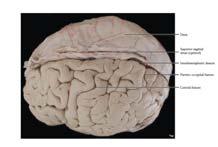 الجزيرة temporal صدغي,occipital paleocortex في عمق الثلم الجانبي (شق فص الجزيرة ھو قشرة دماغية قديمة