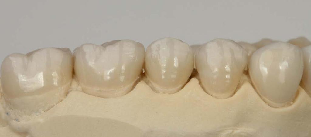 The following case study describes a very complex treatment plan, involving the restoration of the complete dentition, and it illustrates the successful outcome.