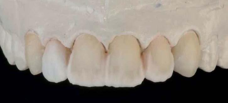In addition, she reported that her teeth had become flatter and that eating caused her pain. Her wish was to have even and natural- looking front teeth and to be able to chew without feeling pain.