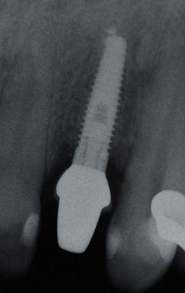 Surgical placement of an implant in a less than ideal position creates a dilemma for the clinician.
