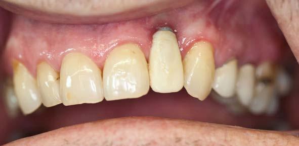 Implant placement in the esthetic zone requires comprehensive diagnosis and treatment planning to achieve optimal results.
