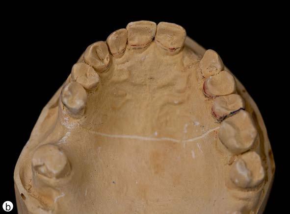 1 Diagnostic wax-ups are required to determine ideal tooth position for placement, emergence profile, esthetics and occlusion.