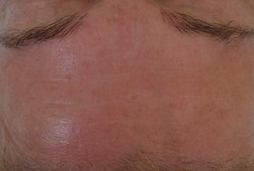 X-WAVE TM THERAPY TREATS MULTIPLE AREAS FROM HEAD TO TOE BEFORE AFTER 2 TREATMENTS شد الجسم استخدام