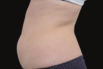 results in treatments of cellulite, scars, and stretch marks.