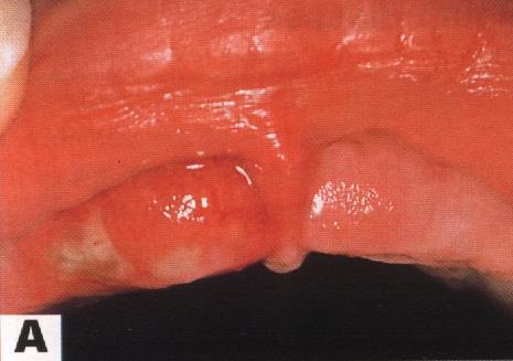 -التهاب اللثة والفم العقبولي البدئي: Primary herpetic gingivostomatitis التشخيص : من خالل: - المظاهر