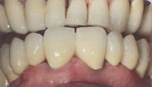 ص«في معرض E2016 Dental Implantology الش كل ٢٥ و ٢٦ : الجس ر المحمول على الغرس ات في فم المريض ة.