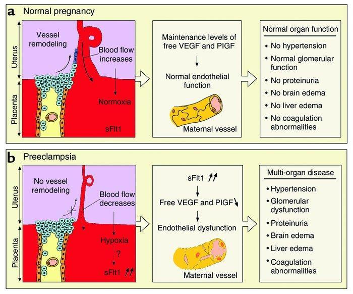 مالحظة قبل البدء: عامل النمو البطاني VEGF يؤدي إلى: اآللية اإلمراضية زيادة العوامل الموس عة لألوعية )مثل NO والبروستاسيكلين(. تشكيل أوعية جديدة في المشيمة )األوعية الحلزونية(.
