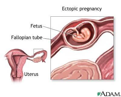 ectopic gestation