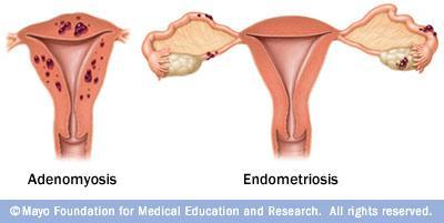 Adenomyosis (or endometriosis