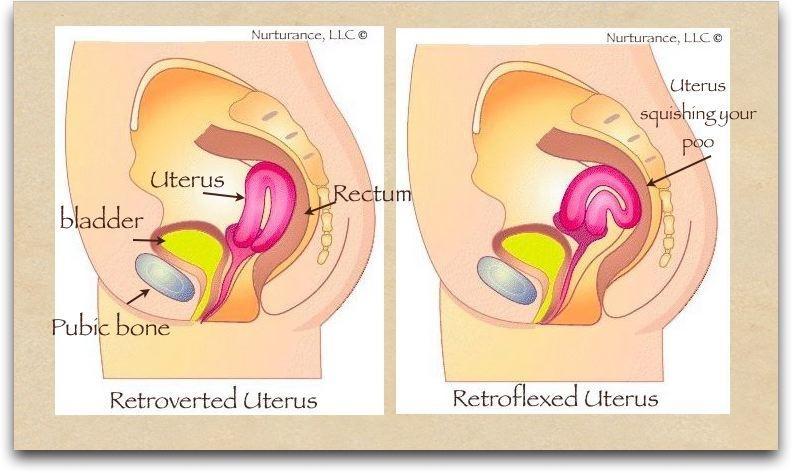 uterine retroversion