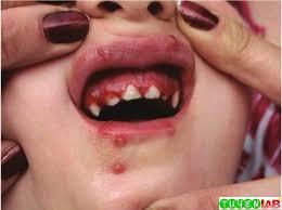 )5( الشكل ) 4 (:الحويصالت الحمئية الشكل ) 5 (:التهاب الفم والمثة العقبولي الحاد المعالجة: يستمر المرض من 14-10 يوما لدى األطفال.