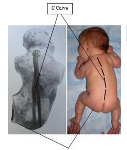 إ- < الجنف الطفولي )infantilescoliosis بخالف الجنف المجهول السبب.