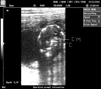 ويجري القياس عادة من السطح القاصي outer distal إلى السطح الداخلي الداني Cranium العلوي لصندوق الدماغ innerللجزء proximal calivarium) ).