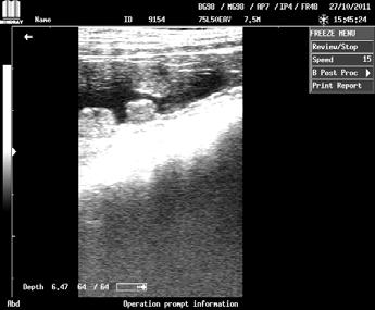 جدار البطن من خالل مشاھدة حويصالت جنينية Embryonic vesicles أو