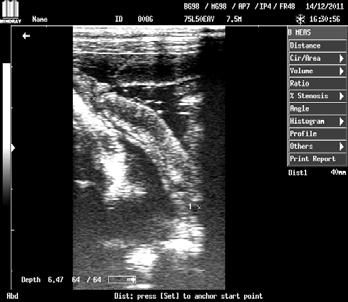 اضالع الصدر Rib length measurement قلب جنين بعمر ٤٧ يوم قلب جنين