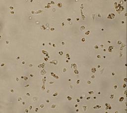 السرطانية BCSCs