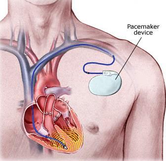 اي جزء من جهاز القلب الرئتين الصناعي يؤدي الوظيفة الرئيسية للقلب