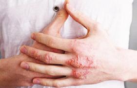 أن اس تخدام املرطب ات واملطري ات يخفف من أعراض األكزيما لكن بما أن األيدي تستخدم لها حل املشاكل الزوجية حيمي األسر من التفك ك تحمينا من الجوع.