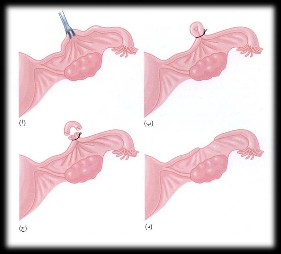 منع الحمل الدائم )التعقيم( PERMANENT CONTRACEPTION الشكل 2-27