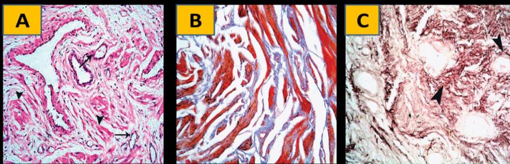 SIMILARITIES IN HISTOLOGY OF MALE & FEMALE GENITALIA Immuno-histochemical studies on male cavernosa have demonstrated the presence of inducible nitric oxide synthase (inos) within male cavernous
