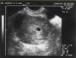 يإستخدام األمواج فوق الصوتية ultrasonography بالزمن الحقيقي يمكن تشخيص كيس الحمل داخل الرحم