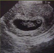fetal image في األسبوع 6.