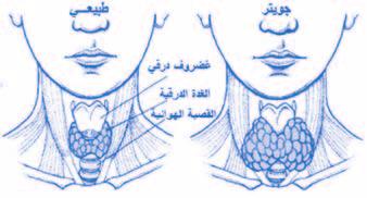 قد ترتفع م ستويات هرمون الغ د ة الدرقي ة ب سكل موؤقت خالل 4-10 الأيام الوىل بعد العالج وذلك ب سبب حترر الهرمونات من الغ د ة الدرقي ة التالفة.