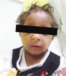 متالزمة رو سال- سيلفر Syndrome( :)Russell-Silver متالزمة وراثية تختلف الأ سباب الوراثية فيها على النحو التايل: وراثة متنحية ) 17.4(. وراثة سائدة ) 8.7(. وراثة مرتبطة بالكرومو سوم )X( ) 74(.