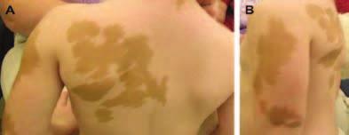 McCune Albright Syndrome ماكيون اأول ي :)15( مت زمة سكل سكل )1 (: مت زمة فانكوين من اأعرا سه التبول الزائد و سرب املاء الزائد واجلفاف ولني العظام وق سر القامة وحمو سة الدم ونق ص البوتا سيوم