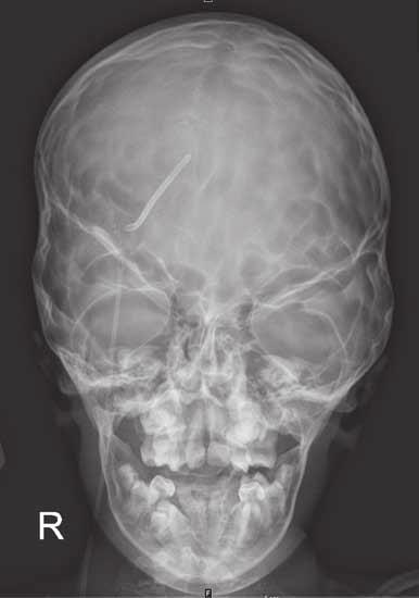 70 اأمرا ض الغ دد ال ص م وال سكري لدى الأطفال أا سباب ه شا شة العظام الثانوي Osteoporosis( :)Secondary توجد العديد من العوامل التي ت ؤوثر سلب ا -منفردة اأو جمتمعة- على كثافة العظام يف الأطفال كما