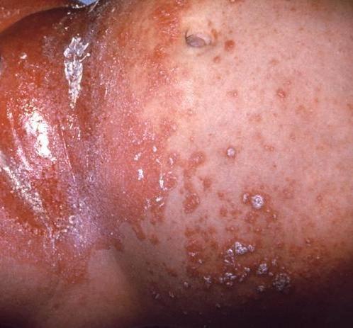 مالمسة للبامبرز( بقى ده Contact Dermatitis