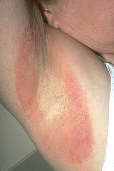 Infection (Cadidiasis) نفس العالج Cream)