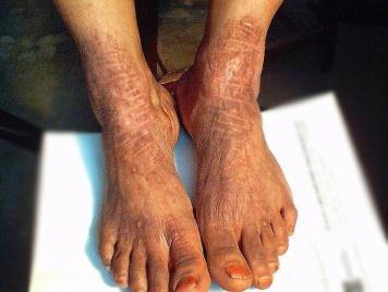 Itching) Fucicort لو هادي