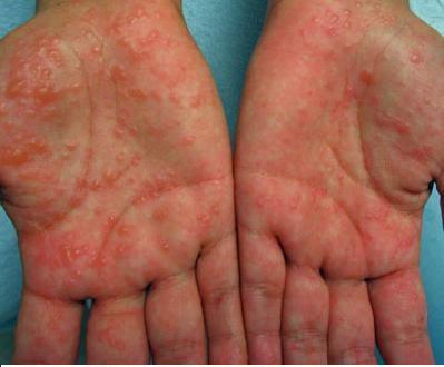 Dermatitis بس هنا ال