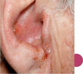 Dermatitis in the ear lobule & side of the neck due to otorreah: - ادي ال Fucicort ear )ألن ال fluid الل نازل من ال ب بقى - ) contact dermatitis وعمل infected لو حد عنده نزلة برد وحصل التهاب ف