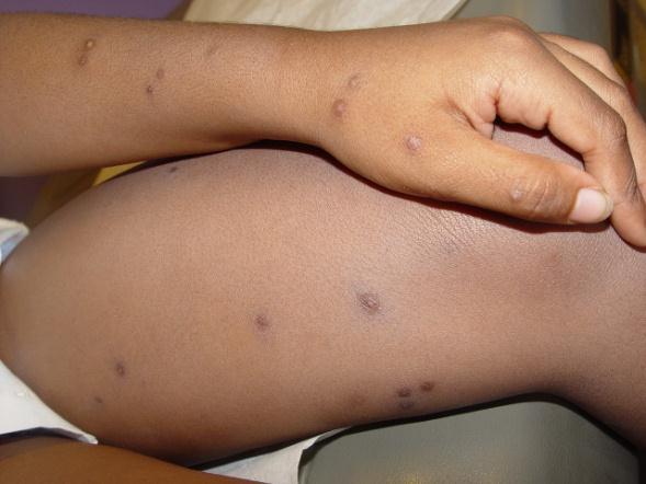 Papules ف إ د ورجل الطفل ب هرش ف ها غالبا من قرص الناموس والحشرات الناموسة لو قرصت الطفل حتى ف صباع رجله الصغ ر ممكن تظهر ف إ ده ورجله )دي حساس ة من