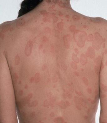 (wheals) (Elevated Edematous Erythematous Evinced) )عال ة وارمة محمرة بتروح لواحدها( إ
