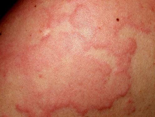 أعمل إ ه ساعتها - سرنجة ف ها Avil) (Amp. Dexa +Amp.