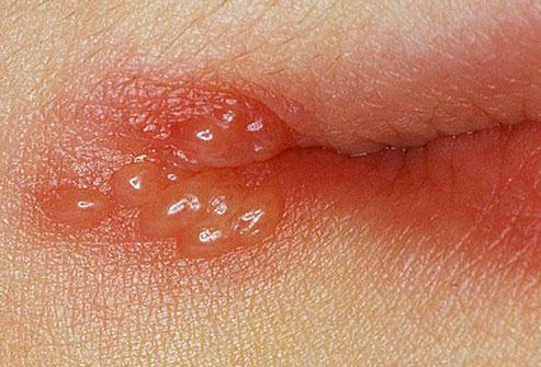 (الحبوب الل بتظهر حوال ن الشفا ف بعد دور البرد) دي viral infection وهتروح لوحدها.