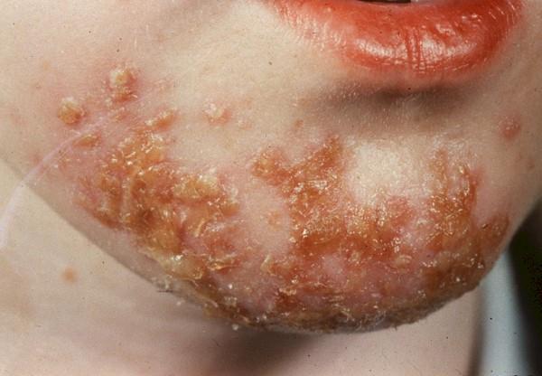 .. Impetigo Herpes - حبا ة وهرش ف ها ففرشت - ب ظهر بعد دور برد - ب بقى ف ها pus & crusts - مجموعة vesicles صغ رة ف ها clear