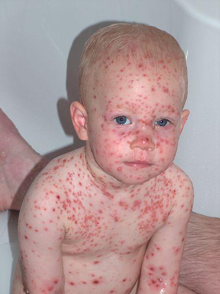 (Vesicles on Erythematous Base) ب بقى.. polymorphic عن شو ة vesicles على شو ة bullae وممكن بقى ف ه pustules كمان ب بدأ ف ال Distribution).