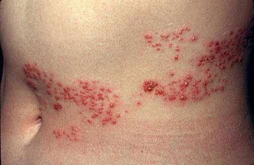 Vesicles on erythematous base Severe pain Varicella zoster virus become latent in the nerve cell bodies of dorsal root, cranial