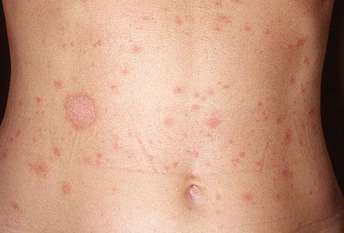 مش مرتفعة عن الجلد Oval shaped Herald patches erythema) (skin scales من جوه لبره Skin Scales Erythema بتبقى عبارة عن بتبقى غالبا حساس ة