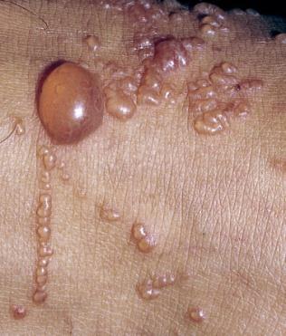An examatous dermatitis caused by exposure to substances in the environment.