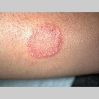 الفرق ب نها وب ن ال pityriasis rosea Tinea Circinata Pityriasis Rosea -