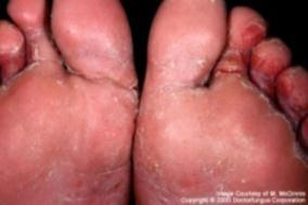 األ lesion بدأ تعافى( ال تص ب ال penis, labia majora or around the anus تسبب حكة شد دة ب ن أصابع القدم و ف باطن