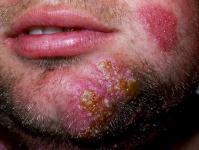 (associated with Tinea Pedis عبارة عن جلد رطب مقشر ب ن األصابع غالبا ب ن الرابع والخامس صاحبها تكون مجموعة من